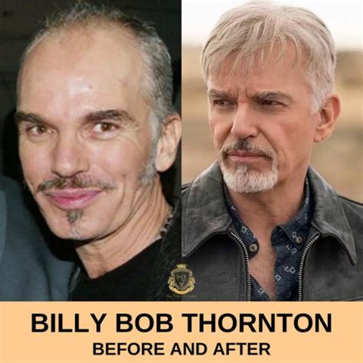 Billy Idol Got Surgery And He's Getting Better